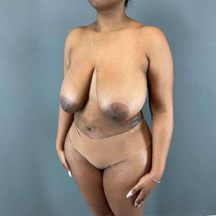 Breast Reduction Before & After Patient #839
