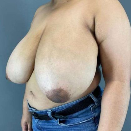 Breast Reduction Before & After Patient #850