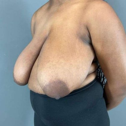 Breast Reduction Before & After Patient #861