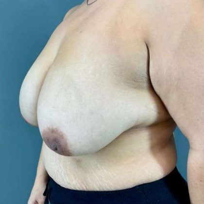 Breast Reduction Before & After Patient #872