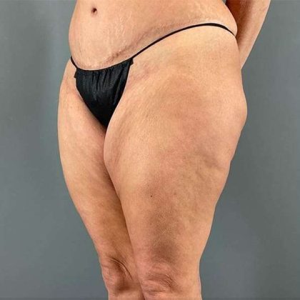 Thigh Lift Before & After Patient #233