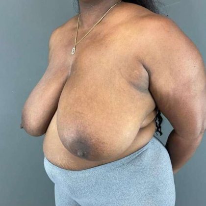 Breast Reduction Before & After Patient #883