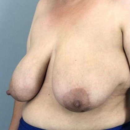 Breast Reduction Before & After Patient #894