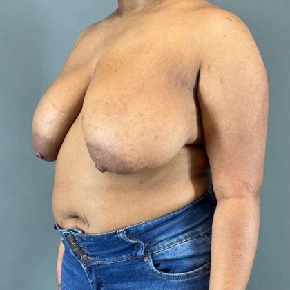 Breast Reduction Before & After Patient #916
