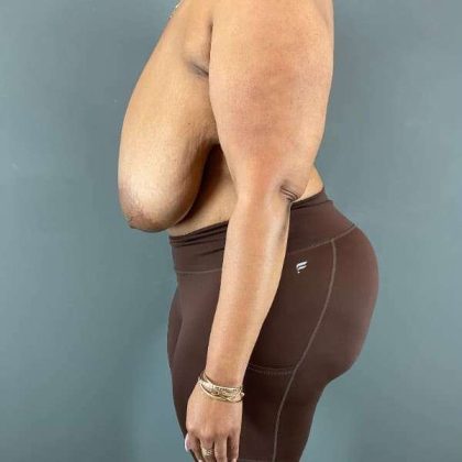 Breast Reduction Before & After Patient #927