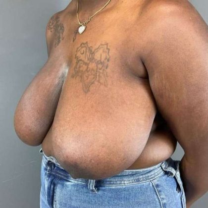Breast Reduction Before & After Patient #938