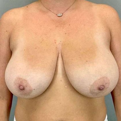 Breast Reduction Before & After Patient #956