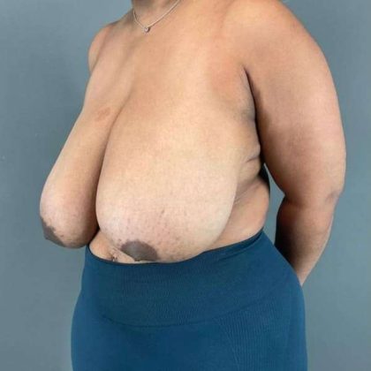 Breast Reduction Before & After Patient #967