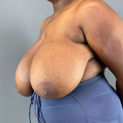 Breast Reduction Before & After Patient #978