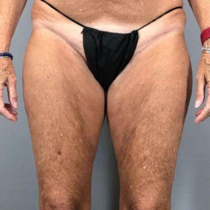 Thigh Lift Before & After Patient #240