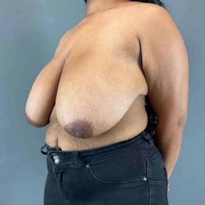 Breast Reduction Before & After Patient #998