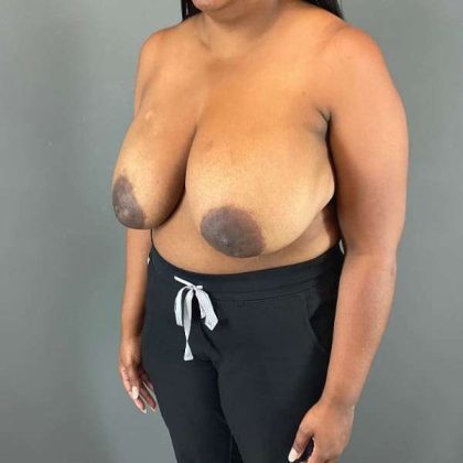 Breast Reduction Before & After Patient #1007
