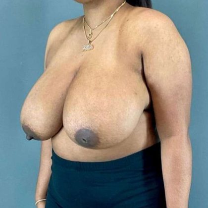 Breast Reduction Before & After Patient #1018