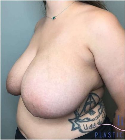 Breast Reduction Before & After Patient #1029
