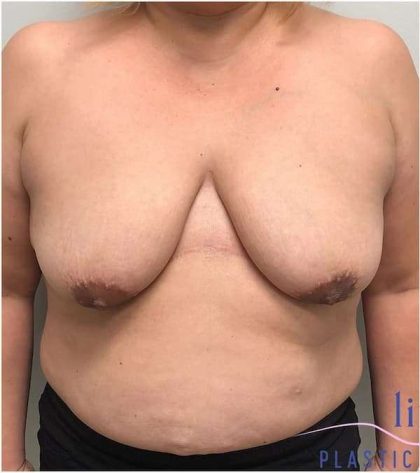 Breast Lift Before & After Patient #1040
