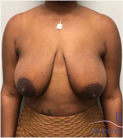 Breast Lift Before & After Patient #1051