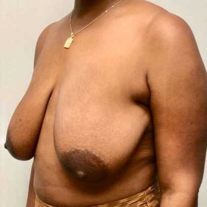 Breast Lift Before & After Patient #1084