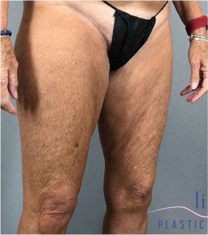 Thigh Lift Before & After Patient #247