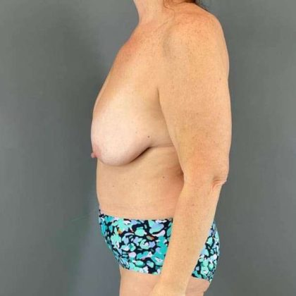 Breast Lift Before & After Patient #1091