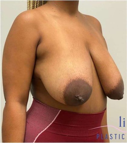 Breast Lift Before & After Patient #1098