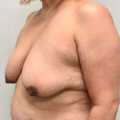 Breast Lift Before & After Patient #1120