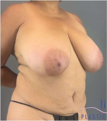 Breast Lift Before & After Patient #1131