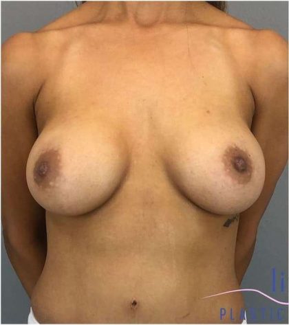Breast Implant Exchange Before & After Patient #1164