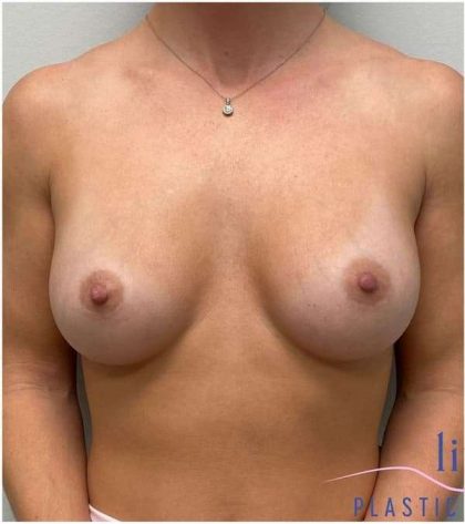 Breast Implant Exchange Before & After Patient #1186