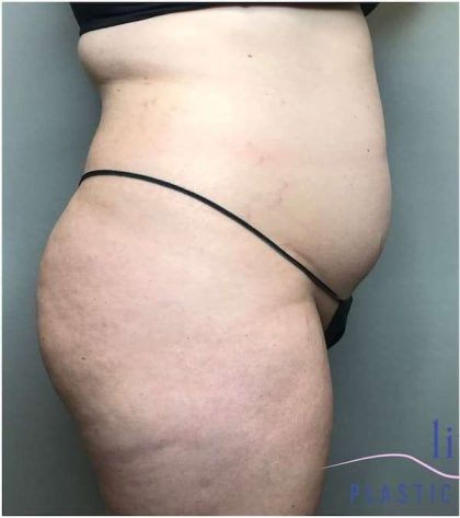 Liposuction Before & After Patient #166