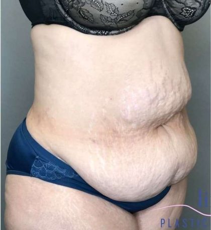 Tummy Tuck Before & After Patient #314