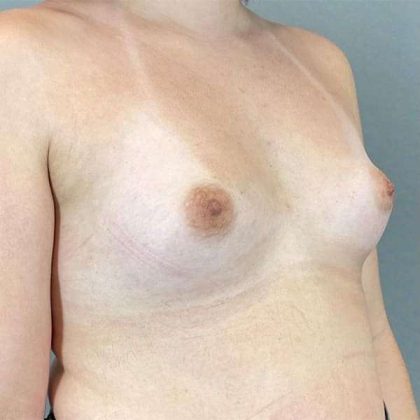 Breast Augmentation Before & After Patient #1362