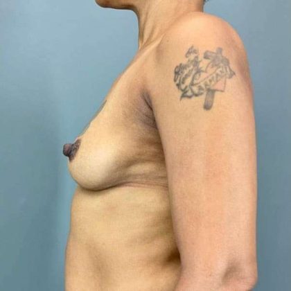 Breast Augmentation Before & After Patient #1428