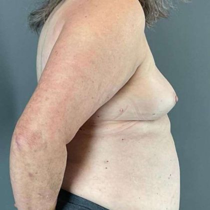 Breast Augmentation Before & After Patient #1450