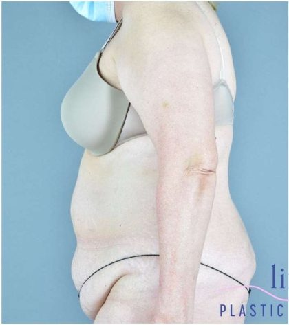 Tummy Tuck Before & After Patient #325