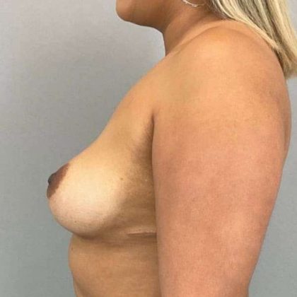 Breast Augmentation Before & After Patient #1483
