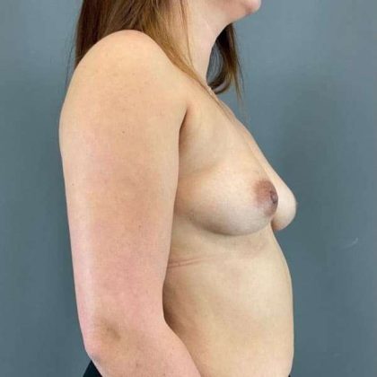 Breast Augmentation Before & After Patient #1514