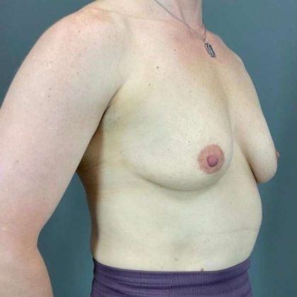 Breast Augmentation Before & After Patient #1547