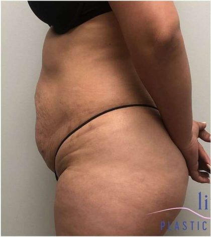 Tummy Tuck Before & After Patient #357