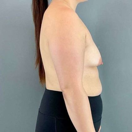 Breast Augmentation Before & After Patient #1591
