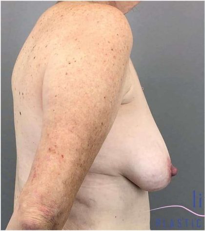 Breast Augmentation Before & After Patient #1613