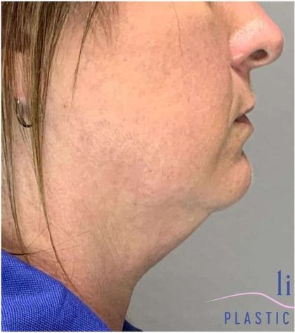 Necktite Before & After Patient #1624