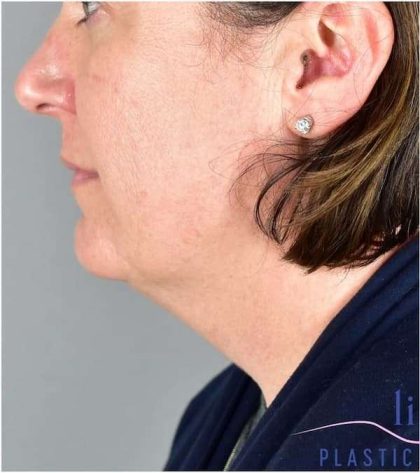 Necktite Before & After Patient #1633
