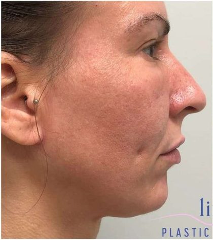 Necktite Before & After Patient #1642