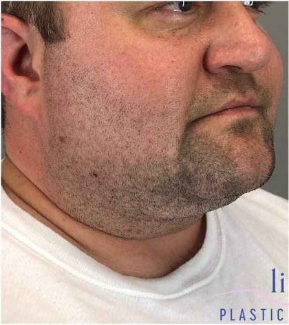 Neck Lift Before & After Patient #1660