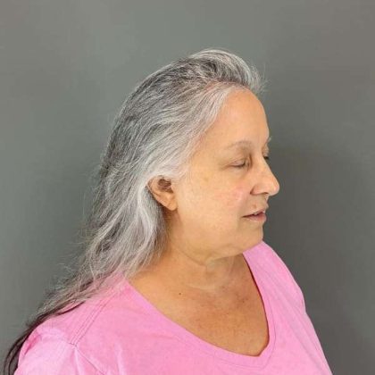 Neck Lift Before & After Patient #1671