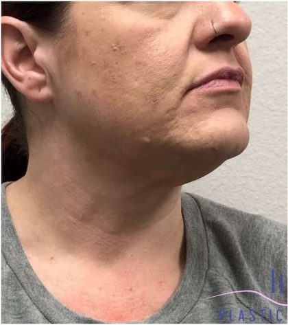 Neck Lift Before & After Patient #1696