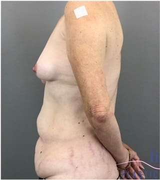 Tummy Tuck Before & After Patient #368