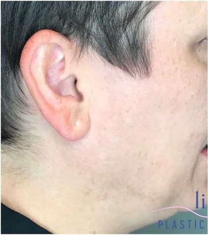 Ear Surgery Before & After Patient #1724