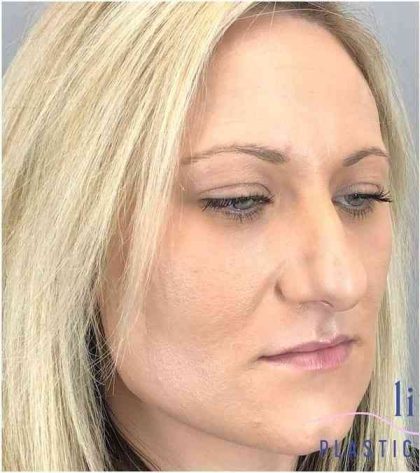 Rhinoplasty Before & After Patient #1807
