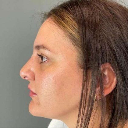 Rhinoplasty Before & After Patient #1818